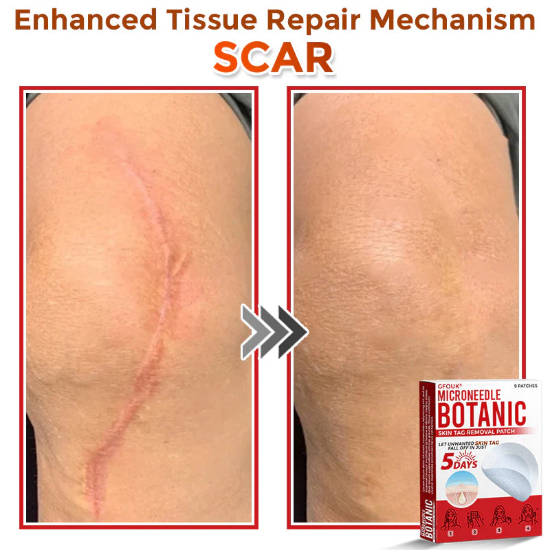 ✔GFOUK® MicroNeedle Botanic Skin Tag Removal Patch 🇺🇸 Made in the USA - Image 10