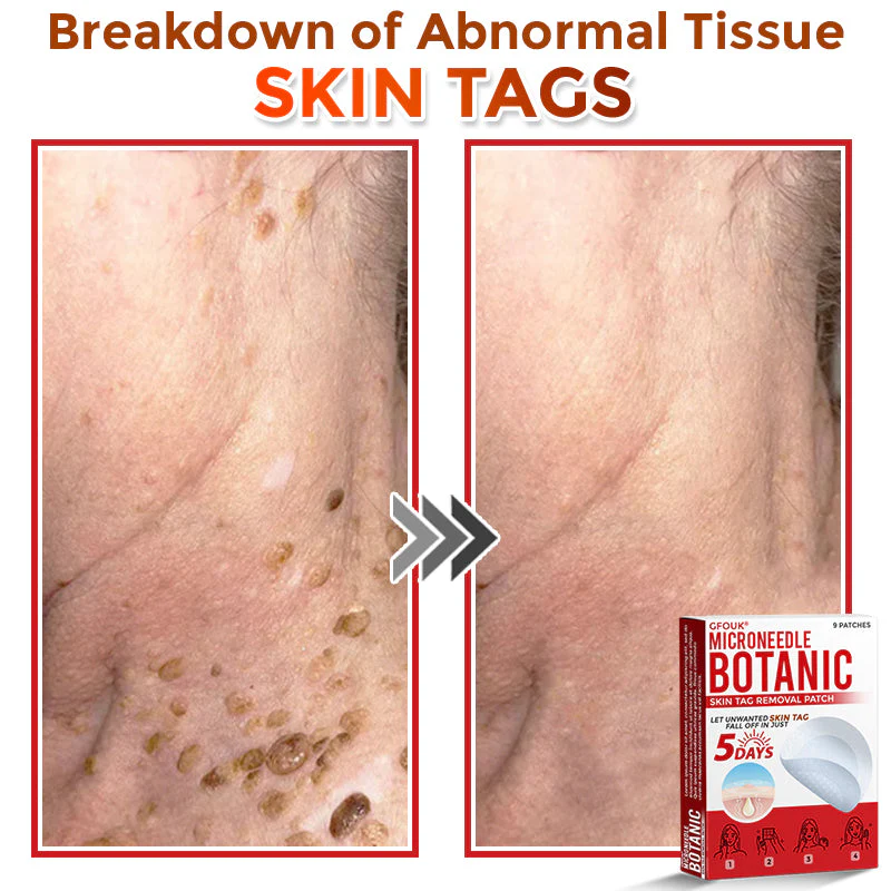 ✔GFOUK® MicroNeedle Botanic Skin Tag Removal Patch 🇺🇸 Made in the USA - Image 6