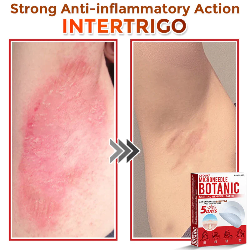 ✔GFOUK® MicroNeedle Botanic Skin Tag Removal Patch 🇺🇸 Made in the USA - Image 8