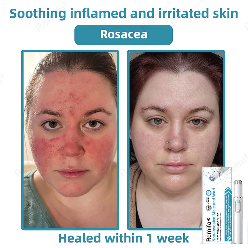 REMIFA® N𝐨n-inv𝐚siv𝐞 𝐌𝐨l𝐞 and W𝐚rt 𝐑𝐞m𝐨v𝐚l L𝐚s𝐞r 𝐏𝐞n 𝐏r𝐨m𝐚x - Image 3