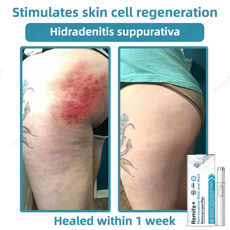 REMIFA® N𝐨n-inv𝐚siv𝐞 𝐌𝐨l𝐞 and W𝐚rt 𝐑𝐞m𝐨v𝐚l L𝐚s𝐞r 𝐏𝐞n 𝐏r𝐨m𝐚x - Image 4