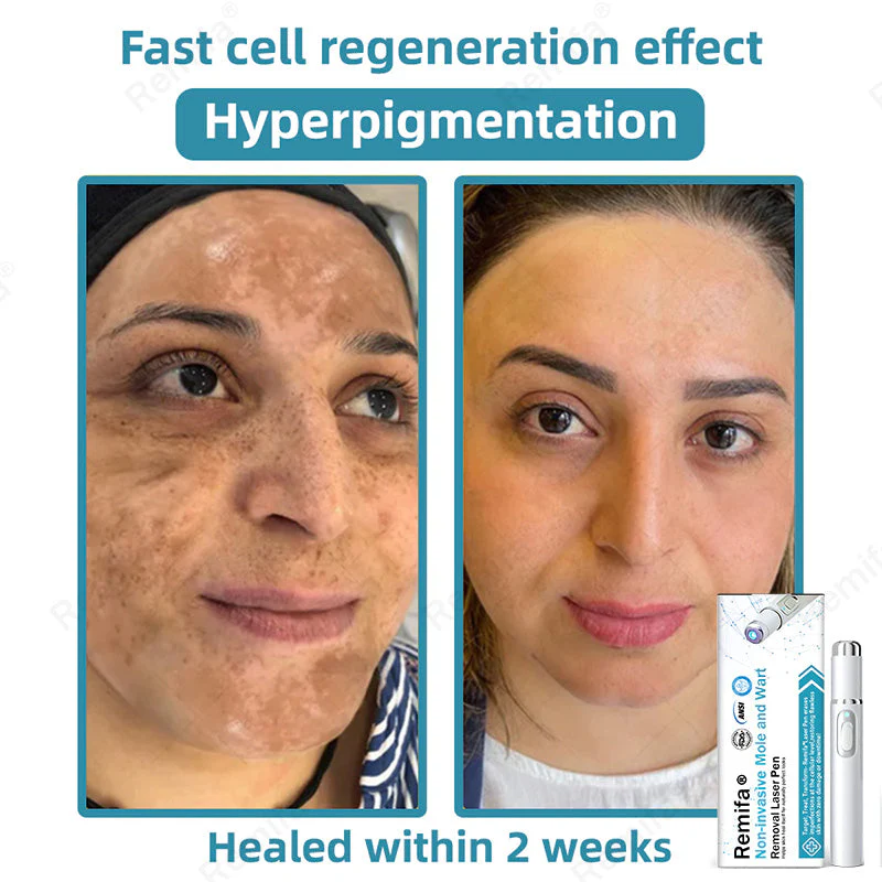 REMIFA® N𝐨n-inv𝐚siv𝐞 𝐌𝐨l𝐞 and W𝐚rt 𝐑𝐞m𝐨v𝐚l L𝐚s𝐞r 𝐏𝐞n 𝐏r𝐨m𝐚x - Image 5