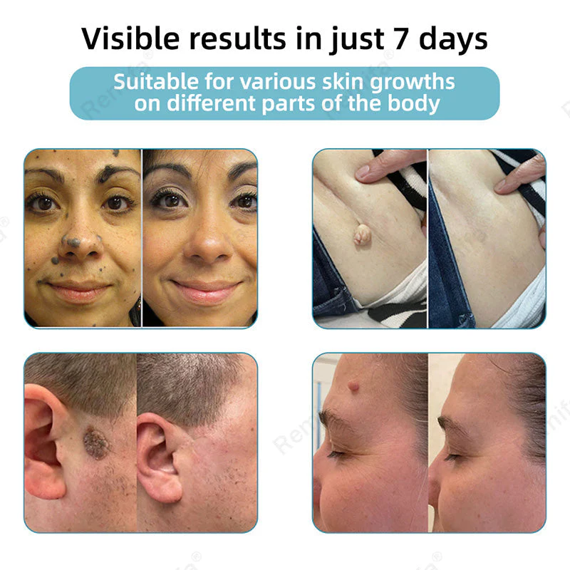REMIFA® N𝐨n-inv𝐚siv𝐞 𝐌𝐨l𝐞 and W𝐚rt 𝐑𝐞m𝐨v𝐚l L𝐚s𝐞r 𝐏𝐞n 𝐏r𝐨m𝐚x - Image 7