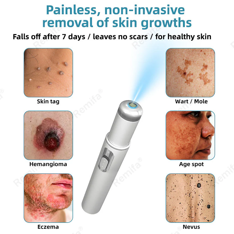 REMIFA® N𝐨n-inv𝐚siv𝐞 𝐌𝐨l𝐞 and W𝐚rt 𝐑𝐞m𝐨v𝐚l L𝐚s𝐞r 𝐏𝐞n 𝐏r𝐨m𝐚x - Image 9
