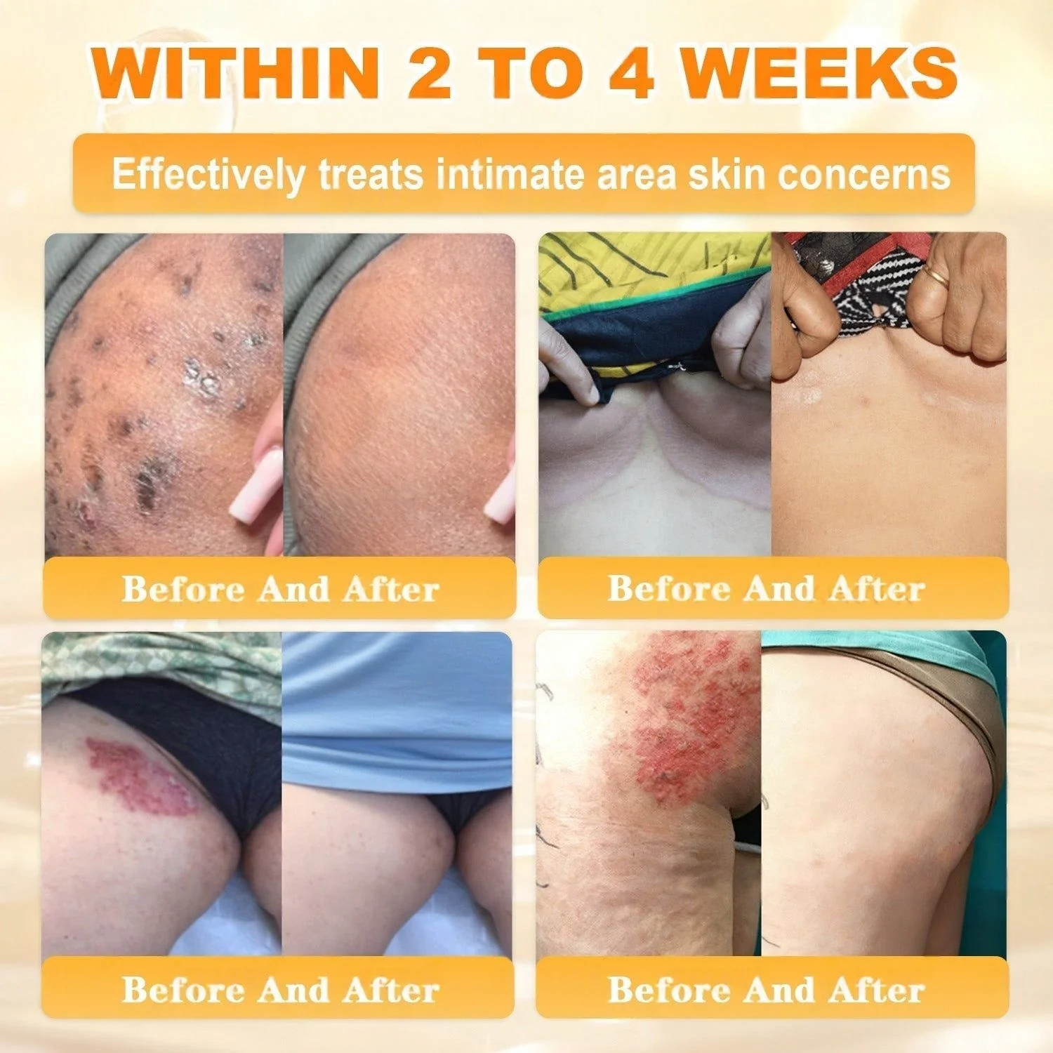 FDA Approved|Rolimey® Bee Venom Skin Restoration Cream (Anti-aging, Hydrating, Skin Repair, Even Tone, Acne and Dark Spot Treatment, Wart and Mole Removal, Psoriasis Relief) - Image 10