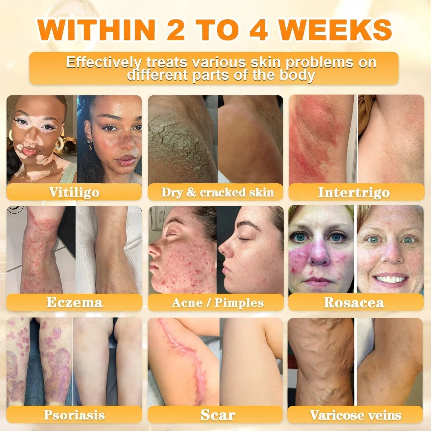 FDA Approved|Rolimey® Bee Venom Skin Restoration Cream (Anti-aging, Hydrating, Skin Repair, Even Tone, Acne and Dark Spot Treatment, Wart and Mole Removal, Psoriasis Relief) - Image 5