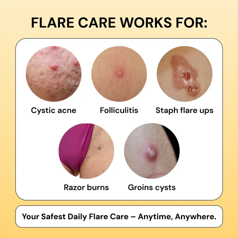 Flysmus®Tea Tree Flare Care| Cystic Acne and Bumps Treatment Skincare Daily Pimple - Image 2