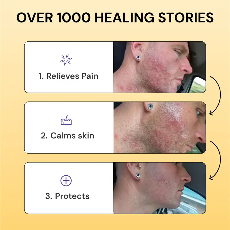 Flysmus®Tea Tree Flare Care| Cystic Acne and Bumps Treatment Skincare Daily Pimple - Image 4
